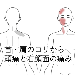 首 肩のこりから始まった 頭痛と顔の痛み 川越の鍼灸 整体 かしの木鍼灸整骨院